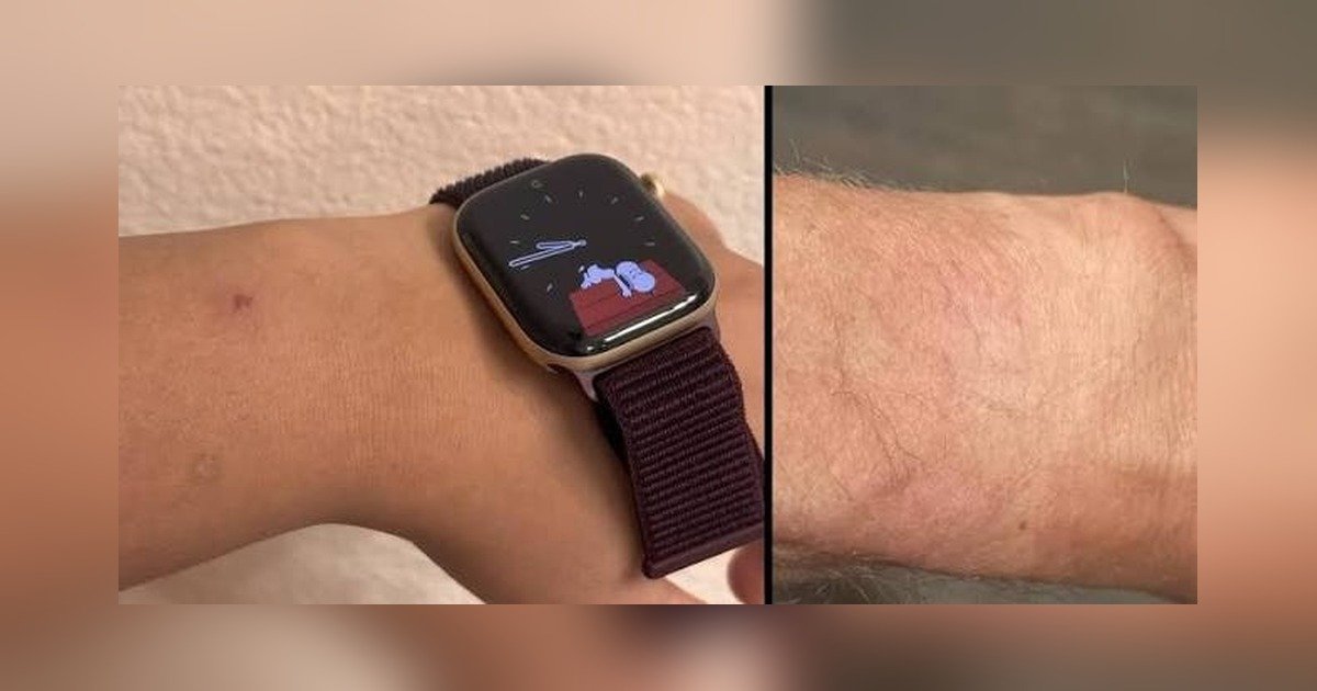 Donos do Apple Watch Series 12 e Ultra 4 relatam irritação na pele; Apple não confirmou causa